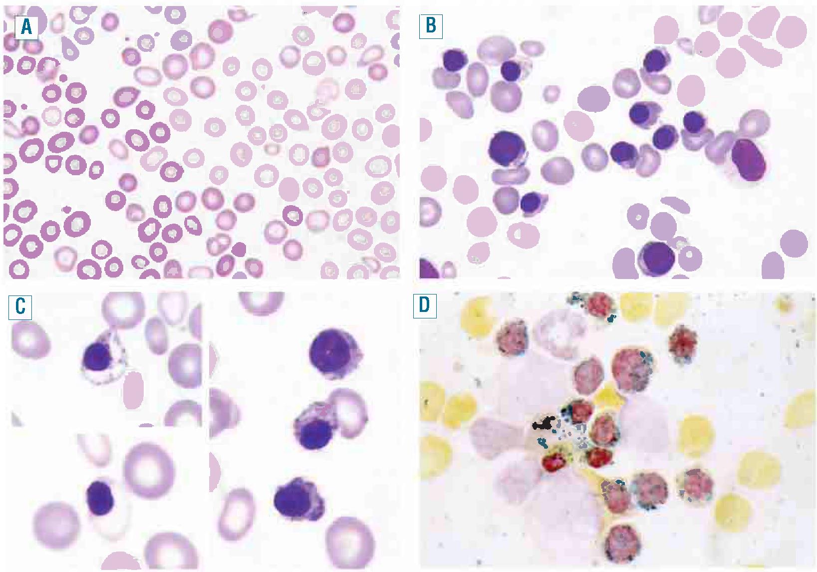 Sideroblastic Anemia The Clinical Advisor 1088