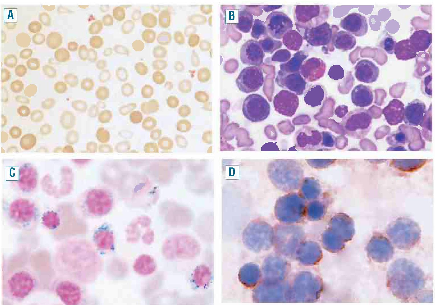 Sideroblastic anemia The Clinical Advisor