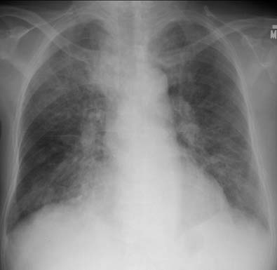 Pneumocystis pneumonia - The Clinical Advisor