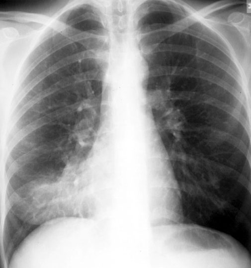 typical-bacterial-pneumonia-the-clinical-advisor