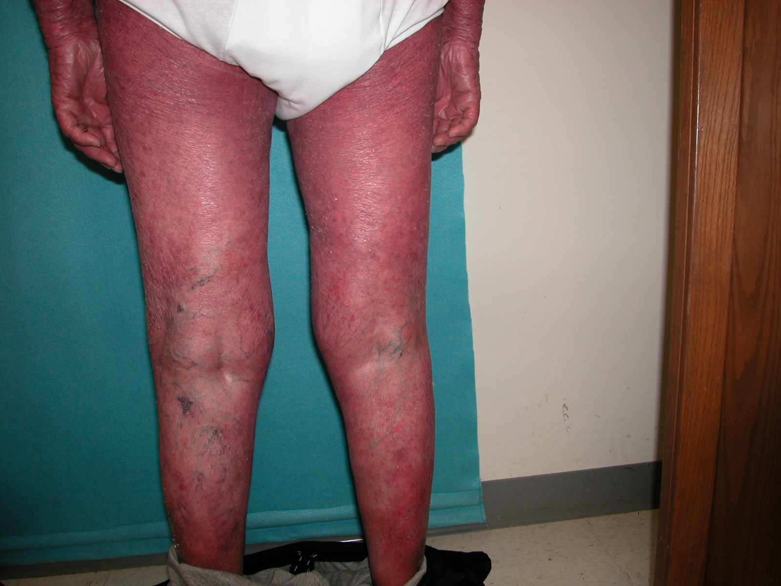 Exfoliative dermatitis (erythroderma) - The Clinical Advisor