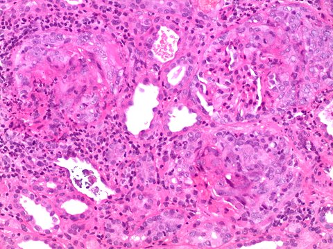 Glomerulonephritis - The Clinical Advisor