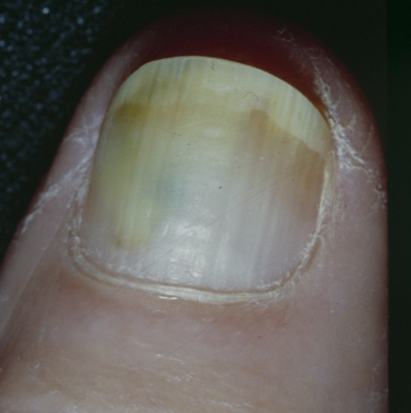 Pseudomonas Bacterial Nail Infection