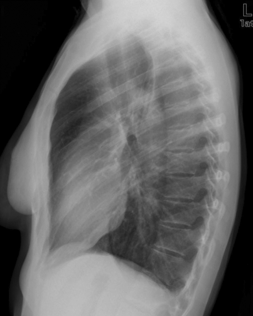 normal lung xray