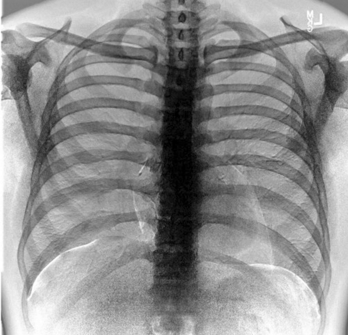 What Is Dual Energy Radiography