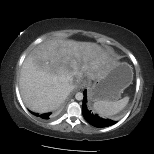 Elevated liver enzymes The Clinical Advisor
