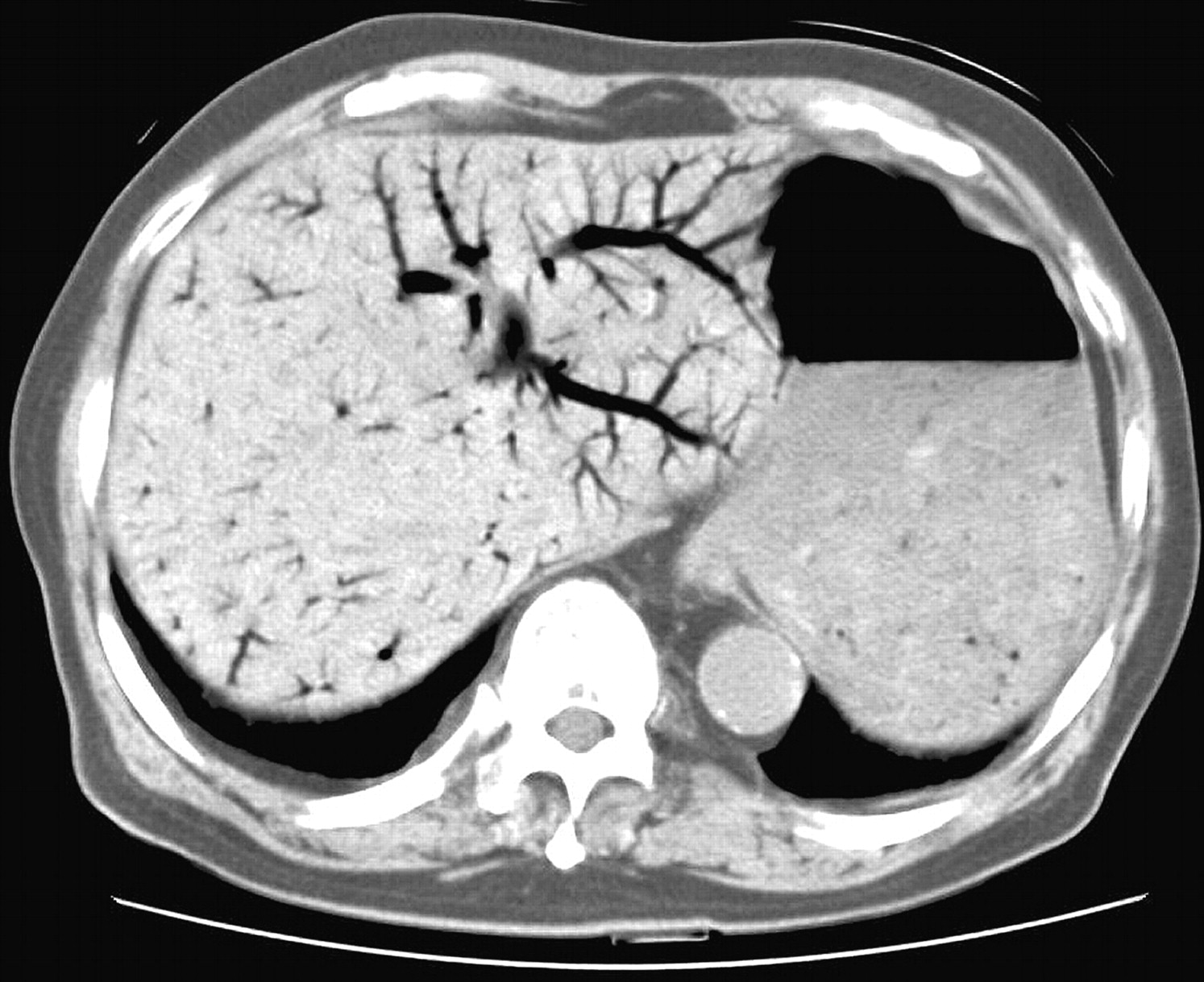 Intra-abdominal infection - The Clinical Advisor