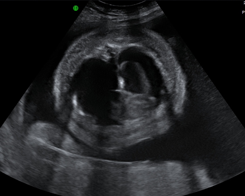 Fetal Hydrops - The Clinical Advisor