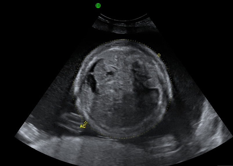 fetal-hydrops-the-clinical-advisor