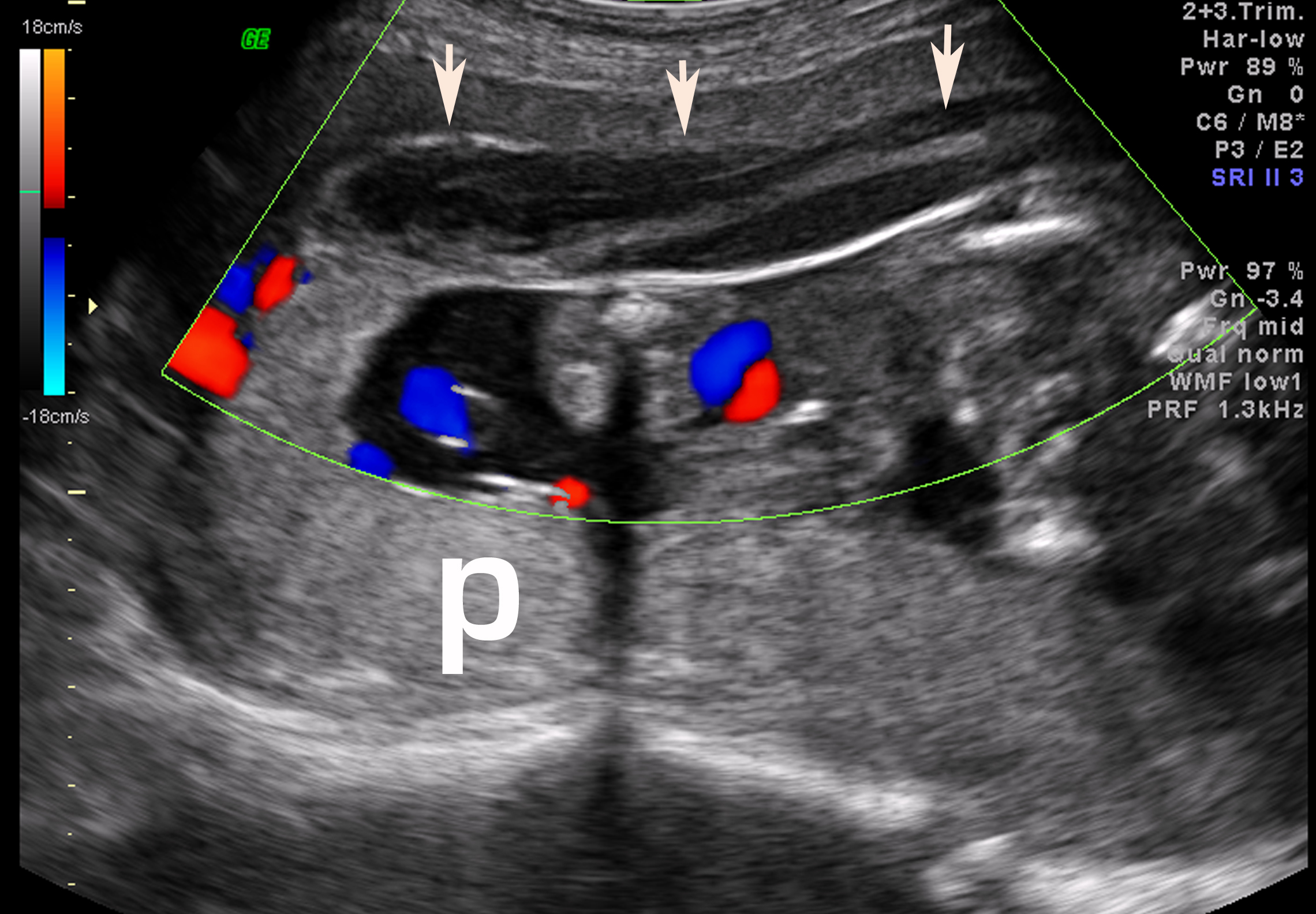 What Is Placenta Abruption