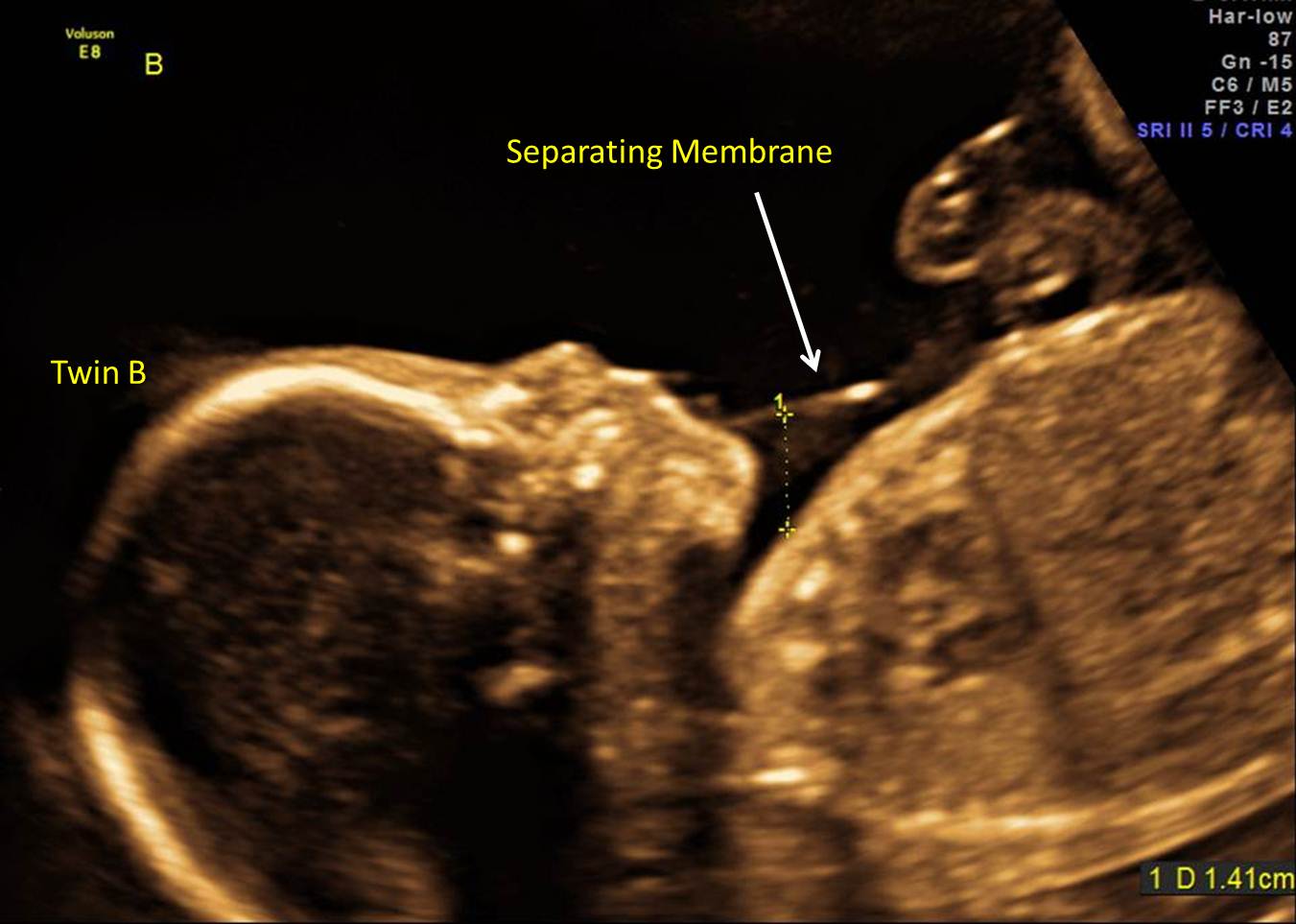 TwinTwin Transfusion Syndrome (TTTS) The Clinical Advisor