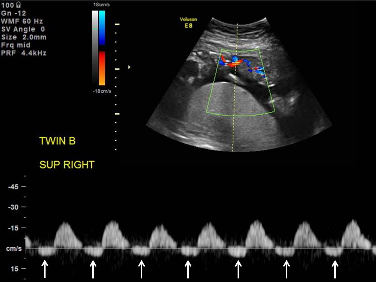 Twin-Twin Transfusion Syndrome (TTTS) - The Clinical Advisor