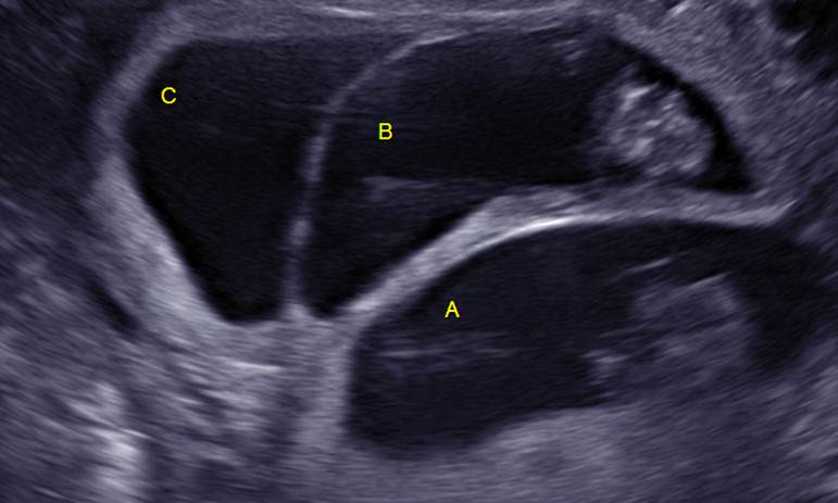 Triplet Pregnancy The Clinical Advisor 