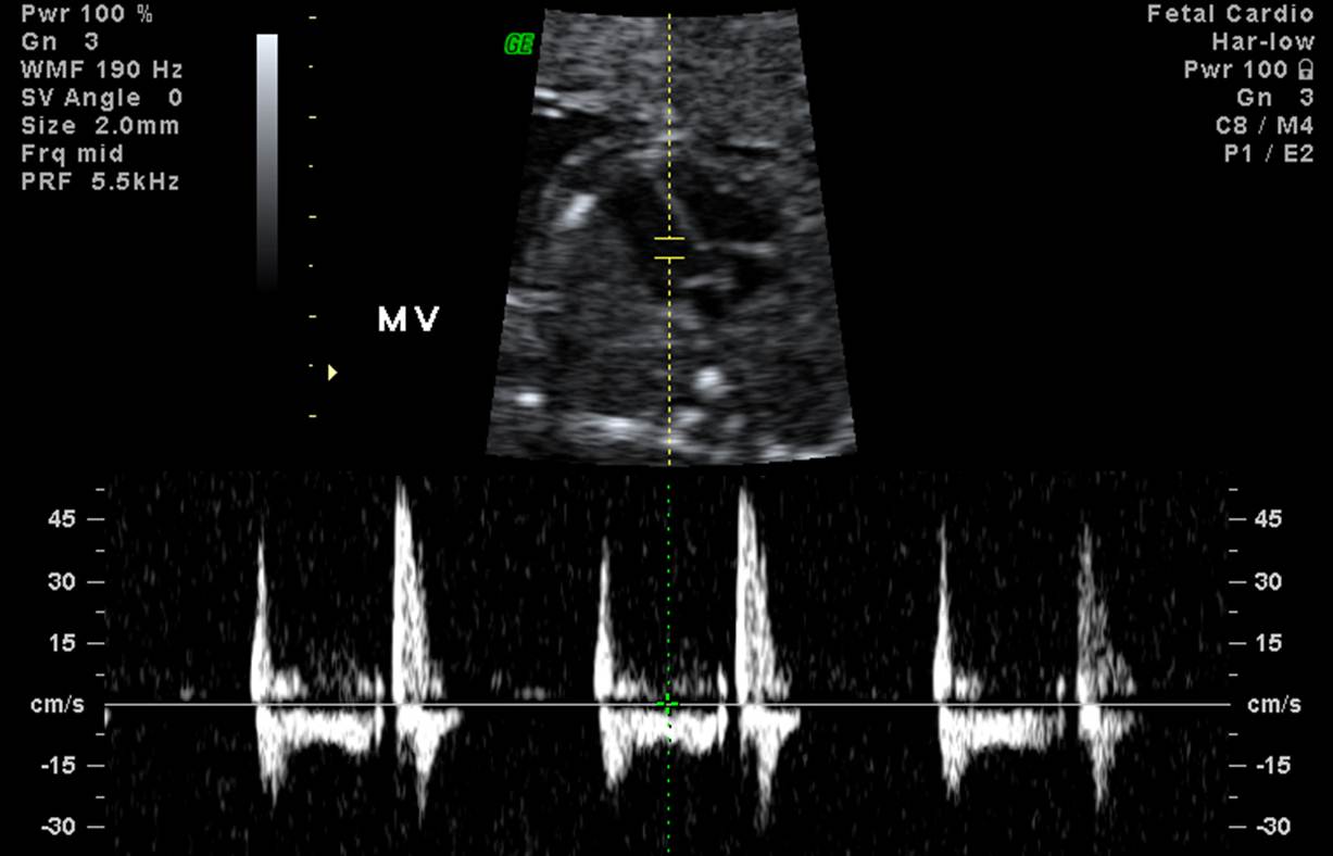 fetal heartbeat