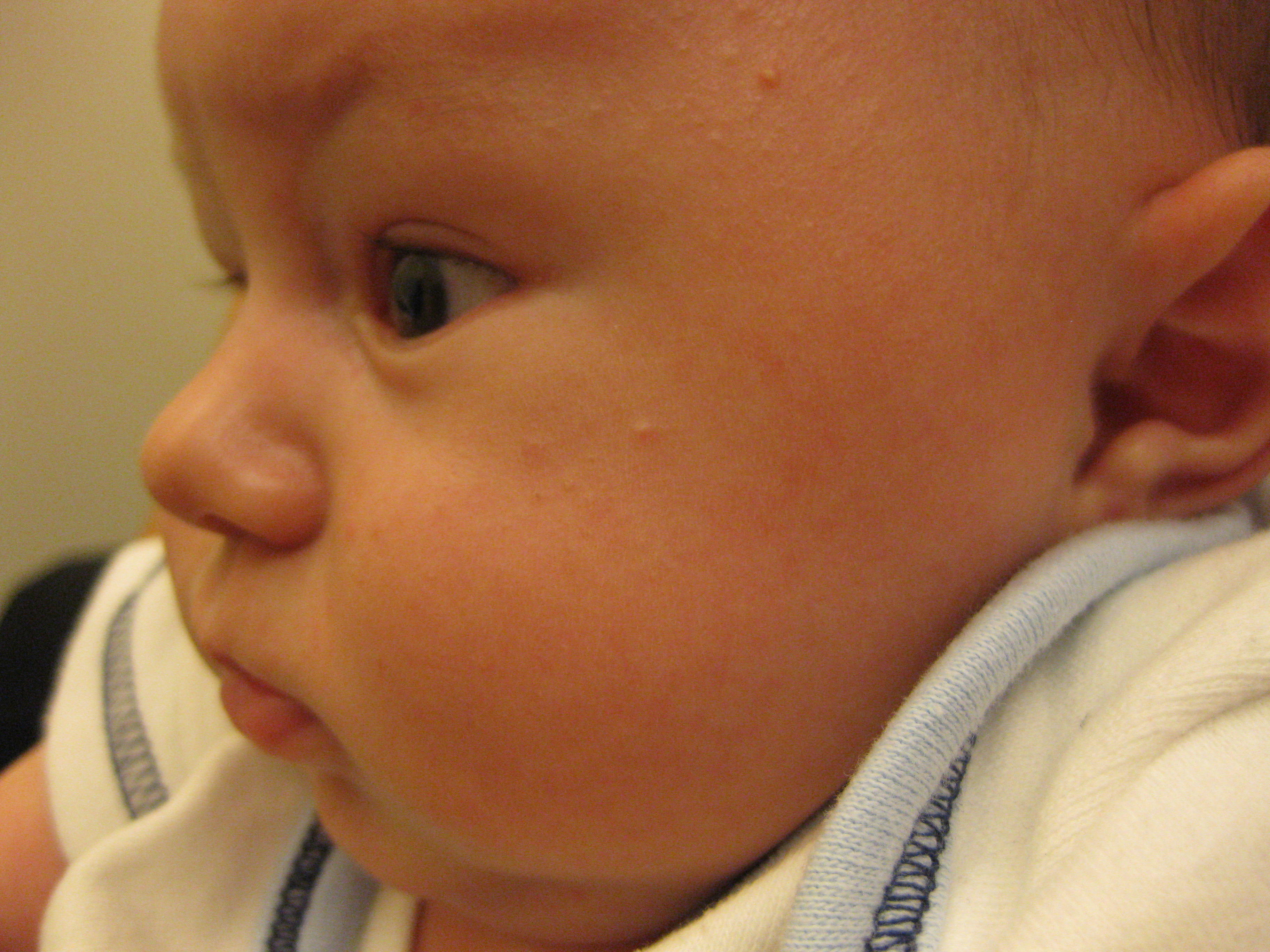 Transient Neonatal Skin Lesions - The Clinical Advisor