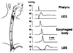 Intraesophageal ph study Intraesophageal ph study