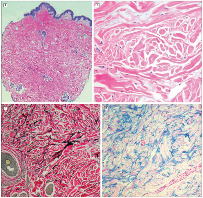 BuschkeOllendorff syndrome (dermatofibrosis lenticularis disseminata