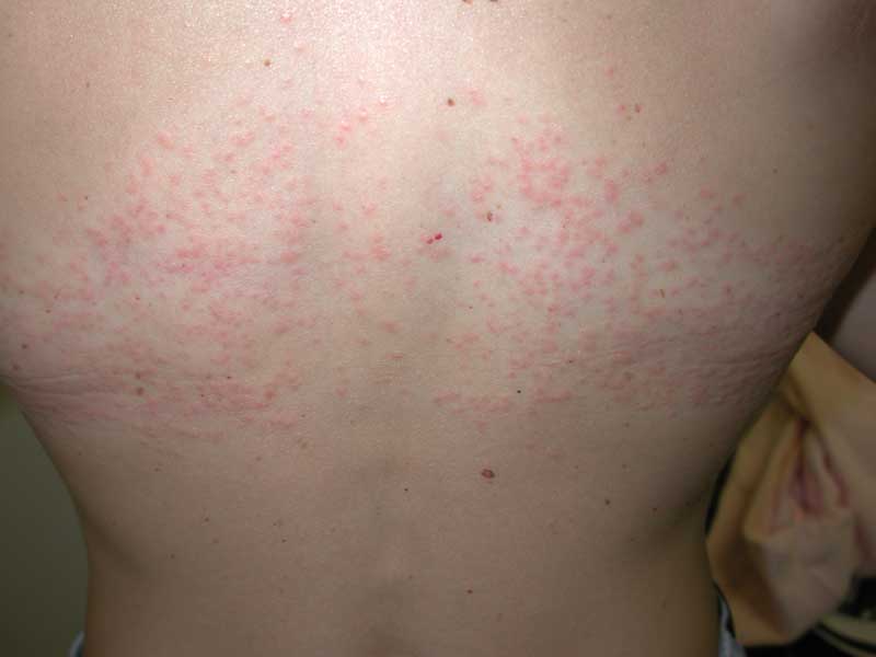 swimmers itch rash pictures