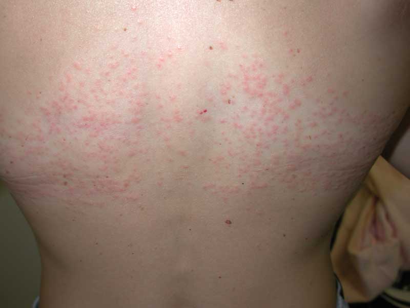 chlorine-rash-vs-swimmers-itch-bflopi