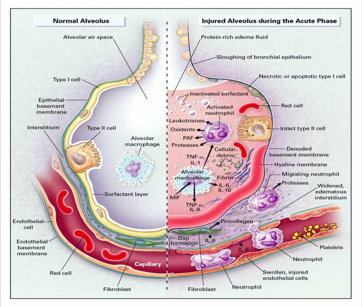 What Does Acute Hypoxemic Respiratory Failure Mean