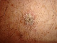 Actinic Keratosis Solar Keratosis Sun Spots The Clinical Advisor