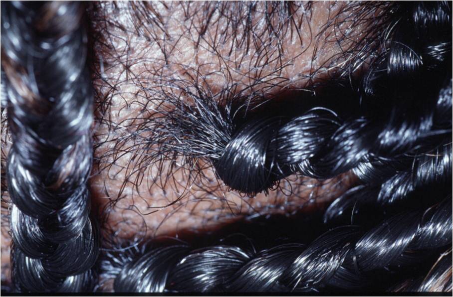 Alopecia Traction The Clinical Advisor alopecia-traction-the-clinical-advisor