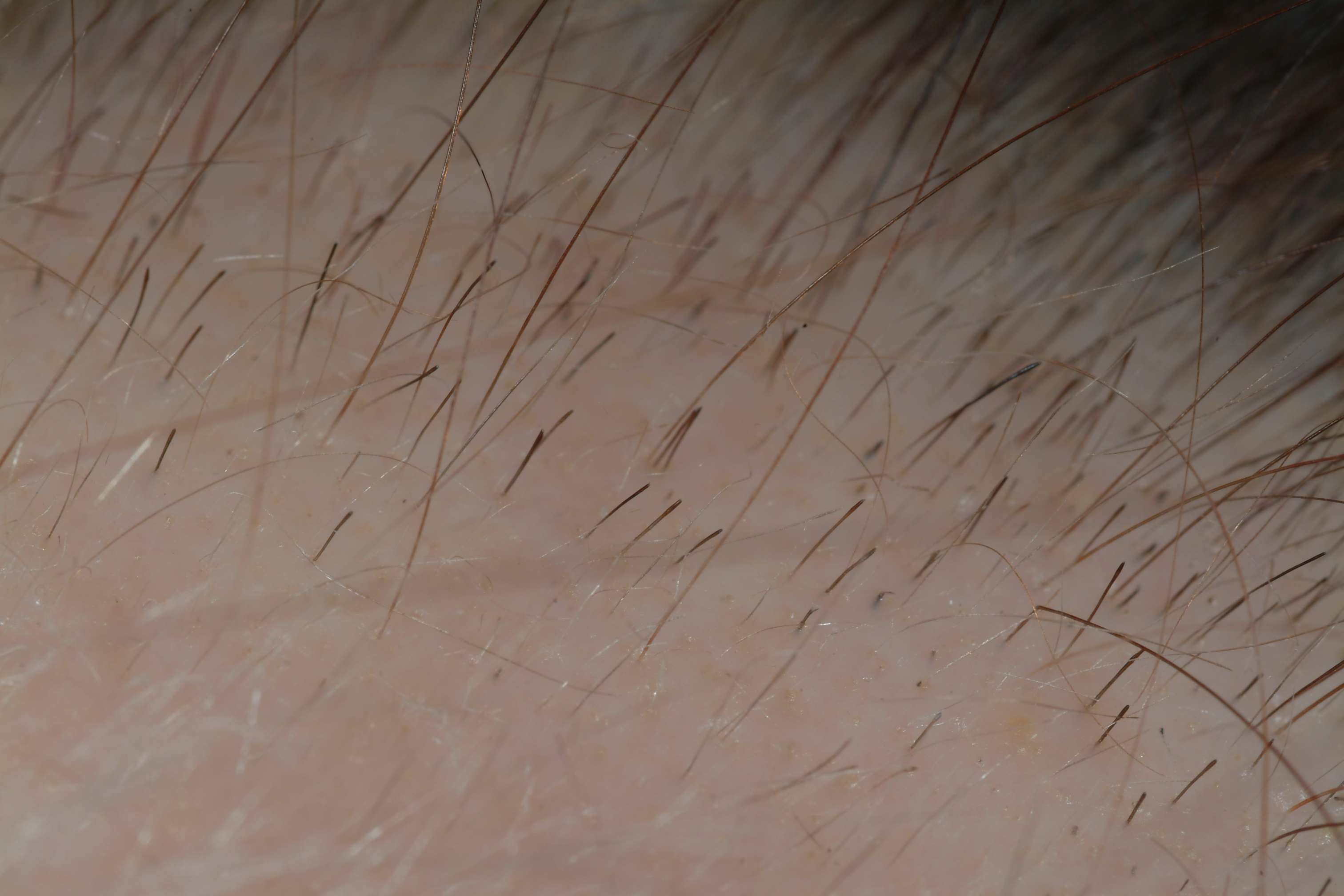 Alopecia areata - The Clinical Advisor