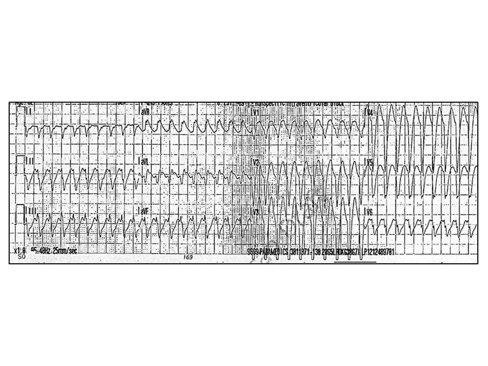 Differential Diagnosis of Wide QRS Complex Tachycardias The Clinical Advisor