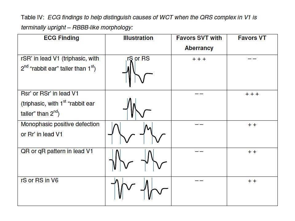 What Is Considered A Wide Qrs