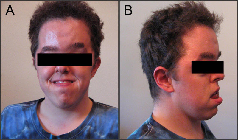 Apert Syndrome (acrocephalosyndactyly, type 1) - The Clinical Advisor