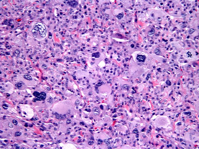 Atypical fibroxanthoma (pseudocarcinoma, fibrosarcoma, paradoxical