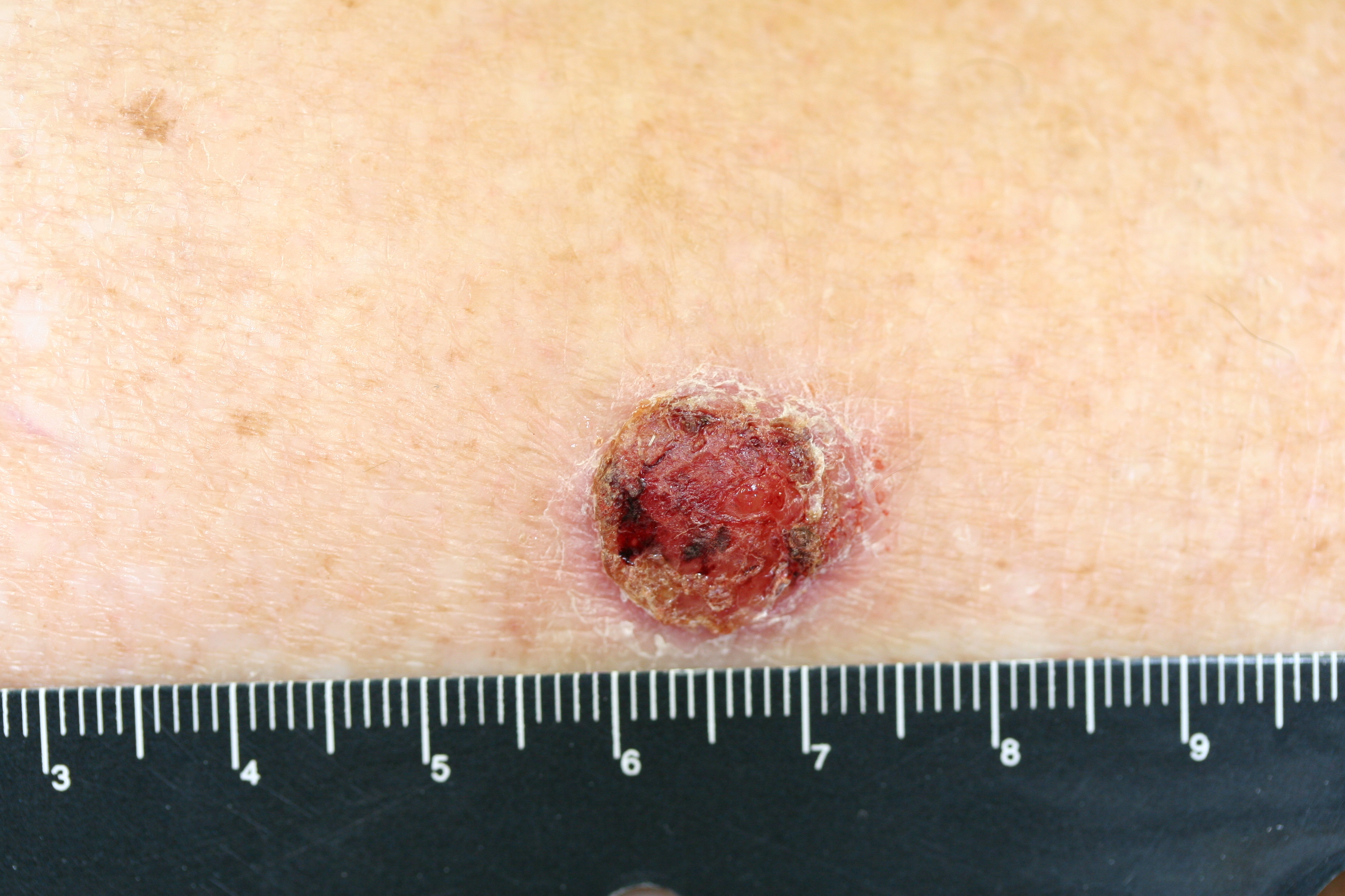 Basal Cell Carcinoma The Clinical Advisor 