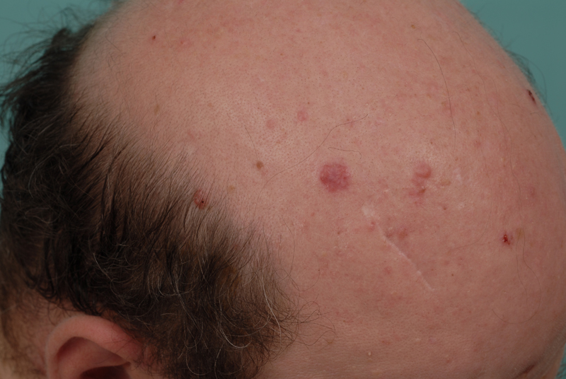 Basal Cell Nevus Syndrome (Gorlin syndrome, Gorlin-Goltz syndrome ...