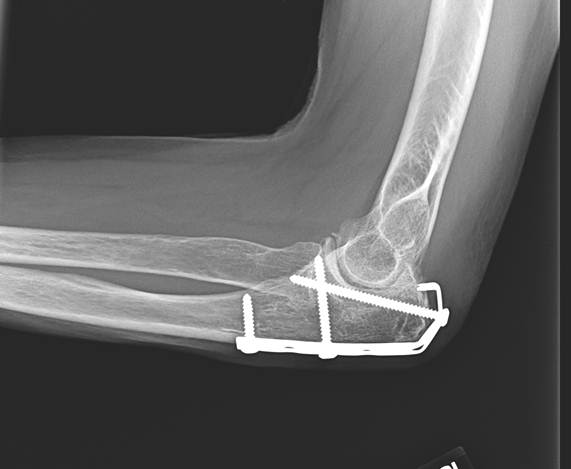 Fractures of the Olecranon and Proximal Ulna - The Clinical Advisor
