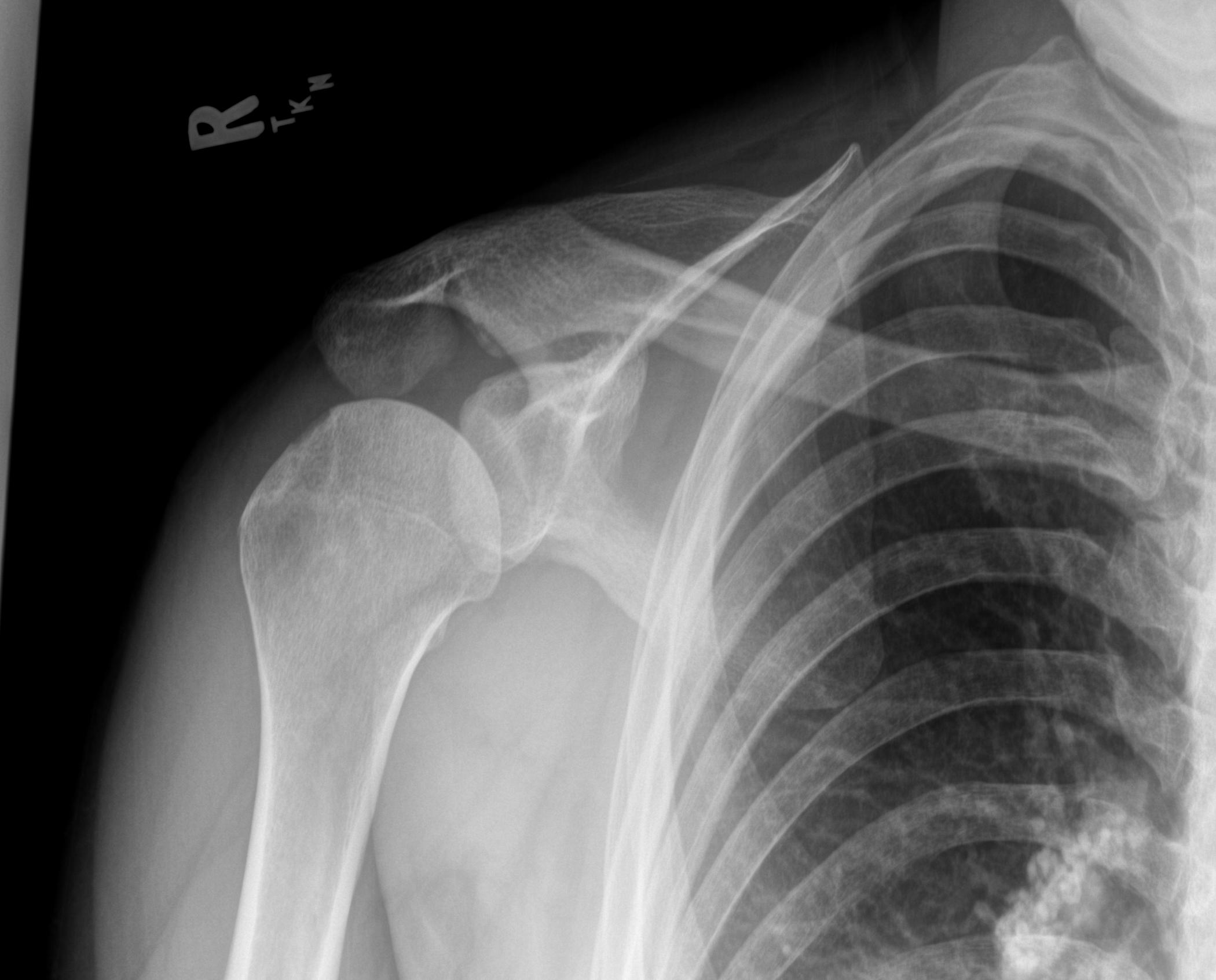 How to Treat Acute Anterior Glenohumeral Instability - The Clinical Advisor