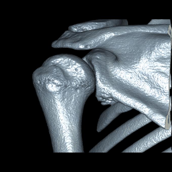 How to Treat Acute Anterior Glenohumeral Instability The Clinical Advisor