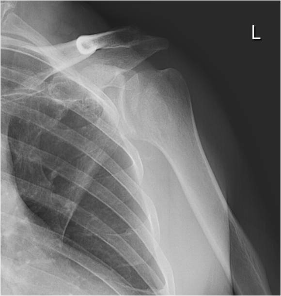 Chronic Glenohumeral Dislocation: Anterior and Posterior - The Clinical ...