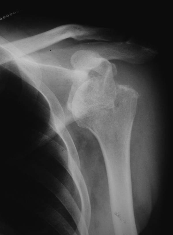 Chronic Glenohumeral Dislocation: Anterior and Posterior - The Clinical ...