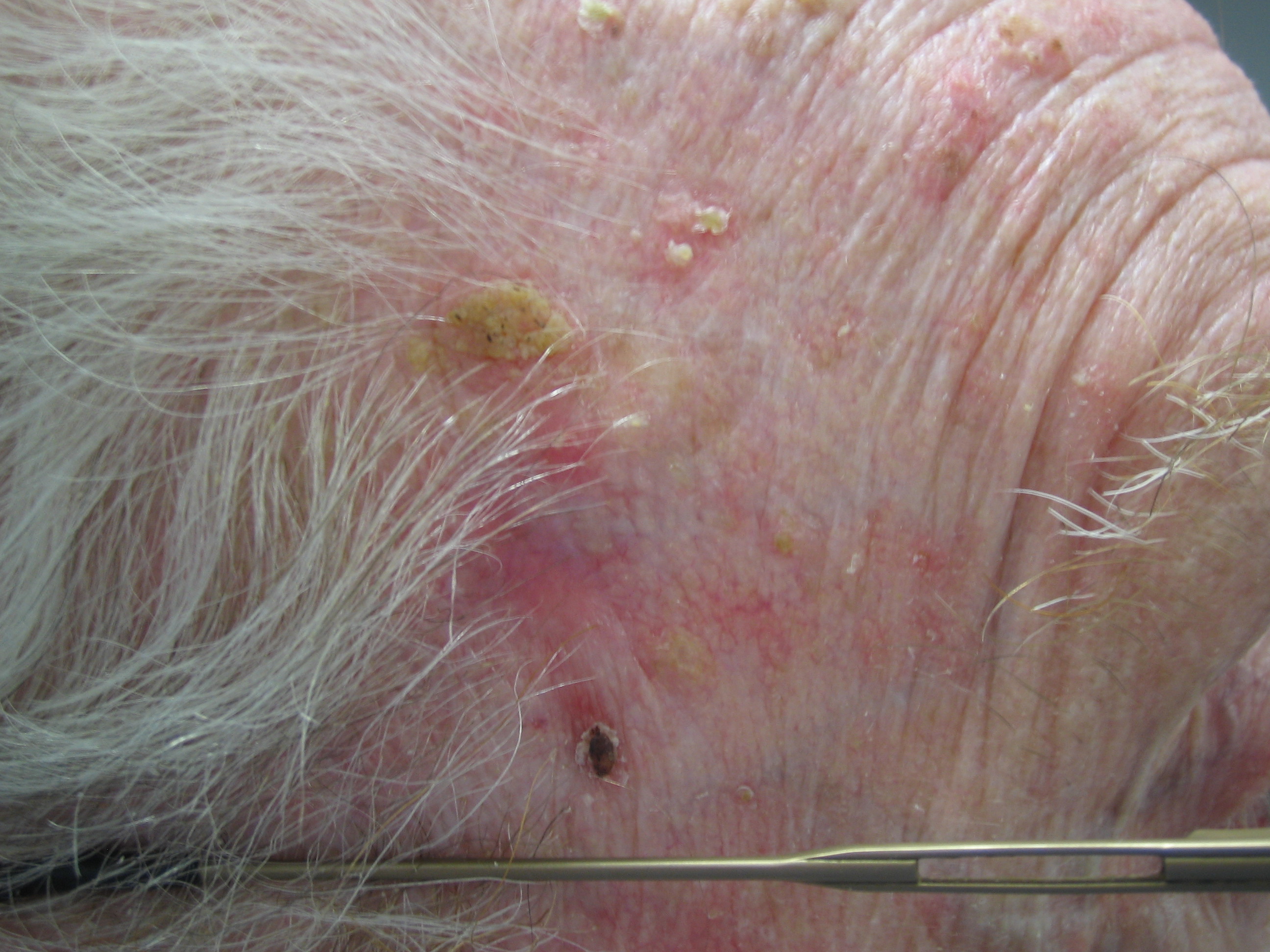 Bowen S Disease Squamous Cell Carcinoma In Situ Erythroplasia Of Queyrat Squamous Cell