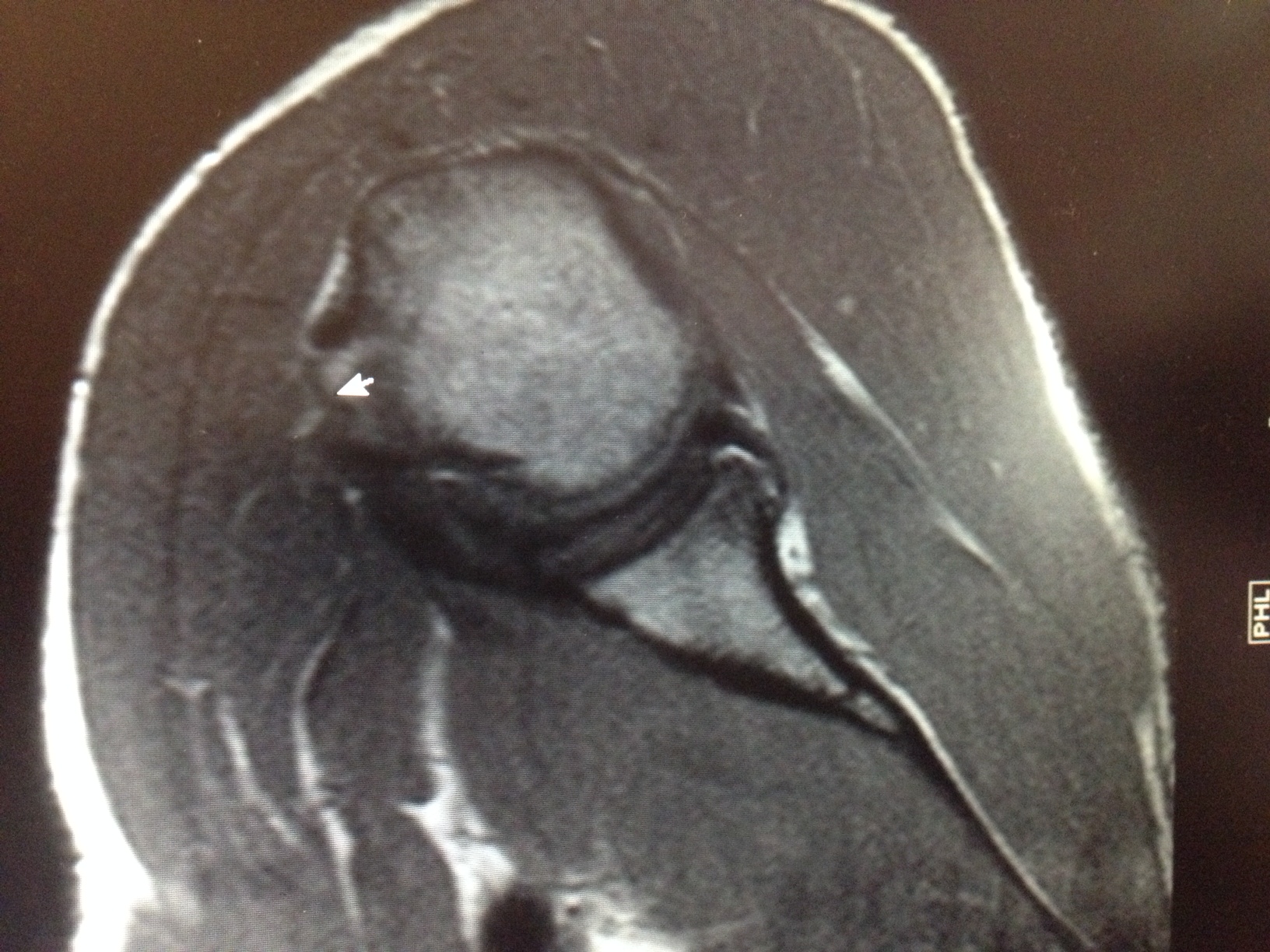 Treatment Of Posterior Labral Tears The Clinical Advisor