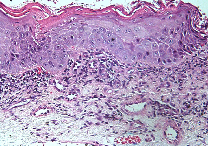 Bowenoid Papulosis Penile Intraepithelial Neoplasia