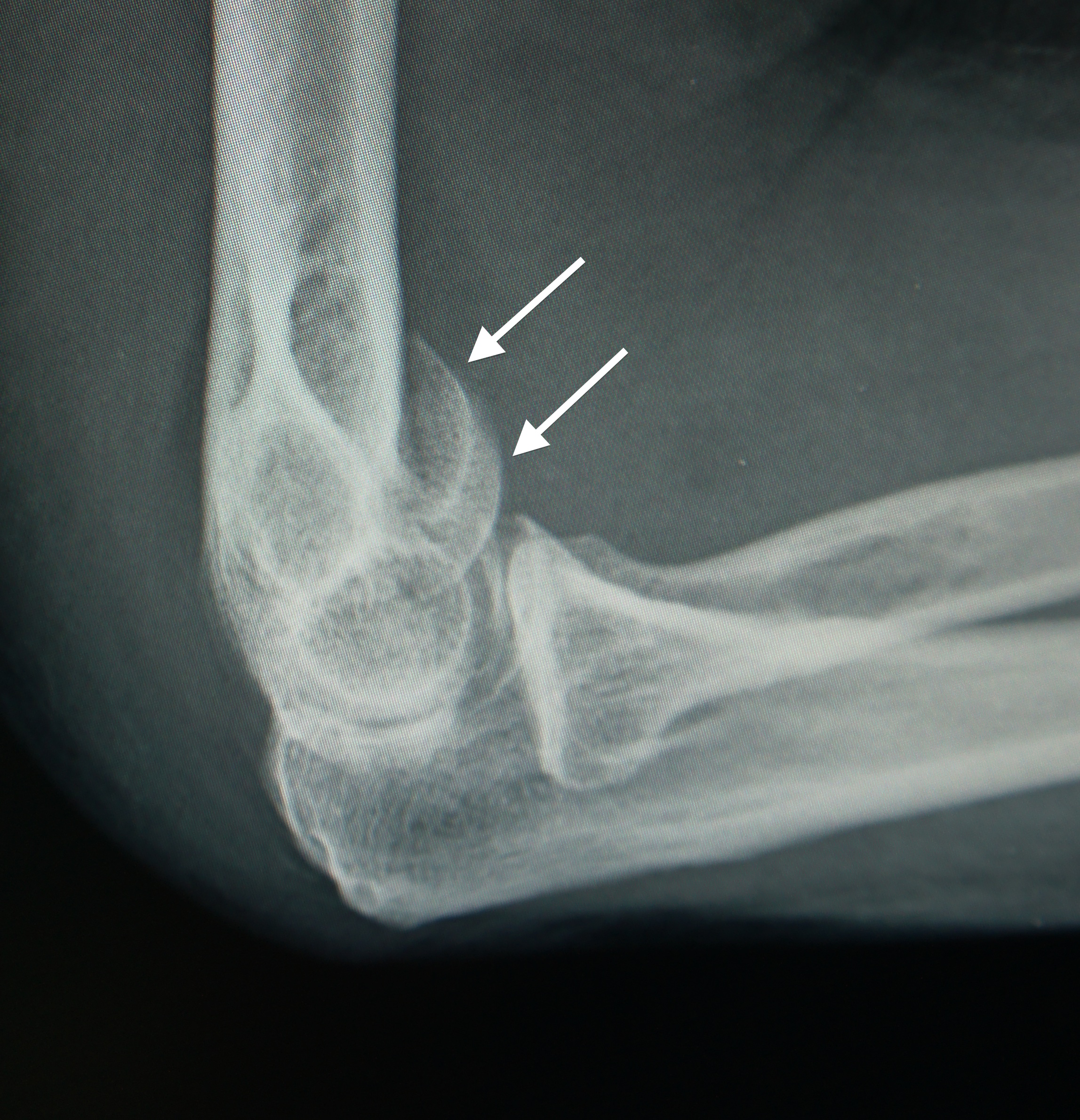 Distal End Of Humerus