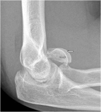 Double Capitulum Double Arc Sign Capitellum | Apparent Capitellar Fractures – UKZFM