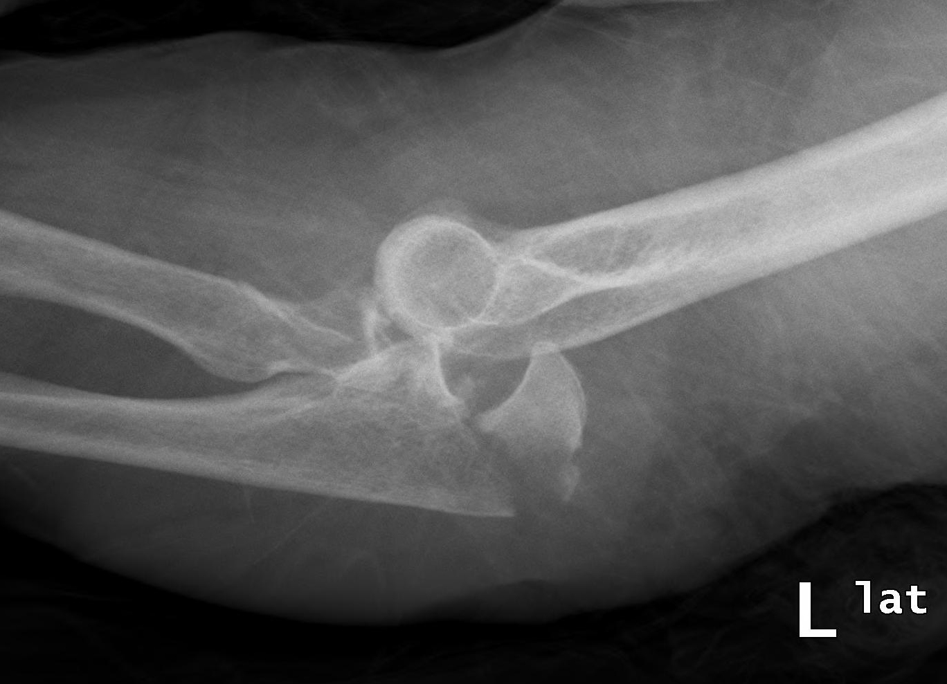 Evaluation and Management of Complex Elbow Dislocations The Clinical Advisor