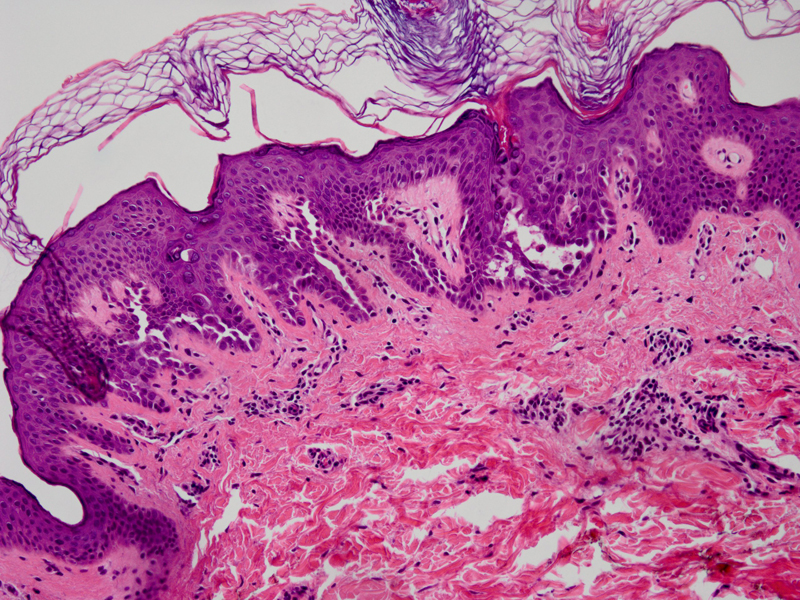 Darier's disease (Darier-White Disease, Dyskeratosis follicularis