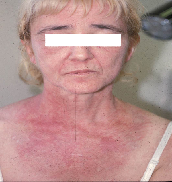 Dermatomyositis The Clinical Advisor
