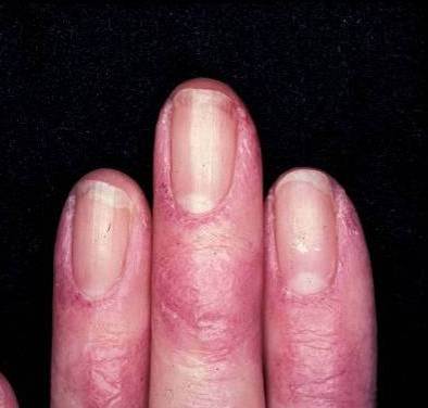 Dermatomyositis - The Clinical Advisor