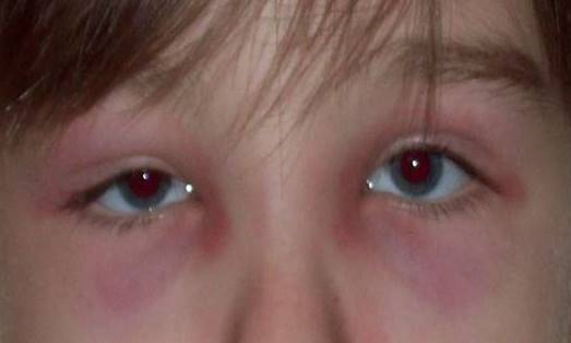 Eyelid Dermatitis (xeroderma of the eyelids, eczema of the 