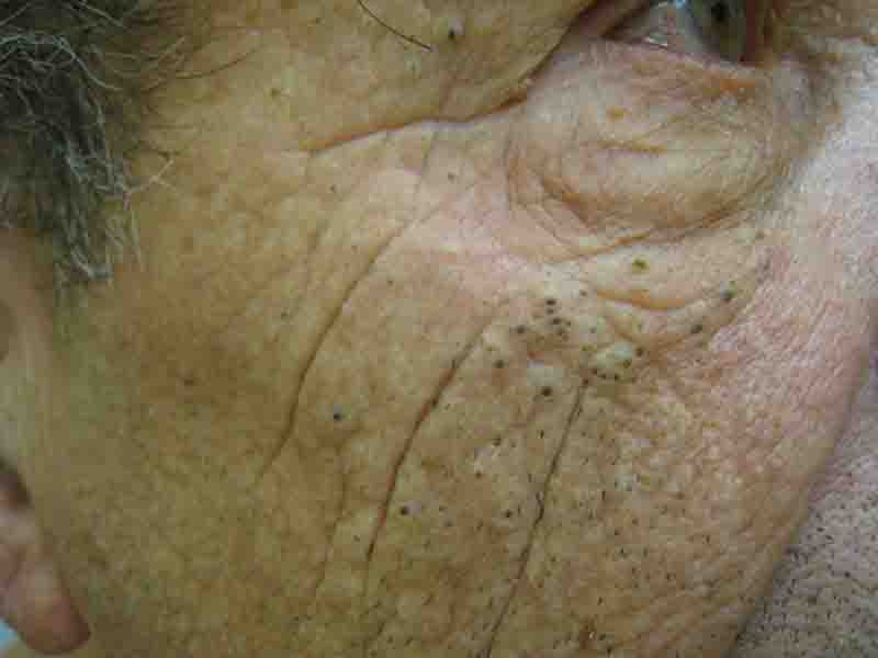 FavreRacouchot Syndrome (Nodular Elastosis [Elastoidosis] with Cysts